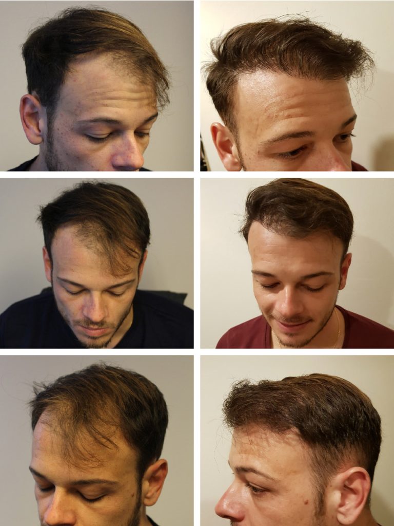Greffe de cheveux avant apres - FUE